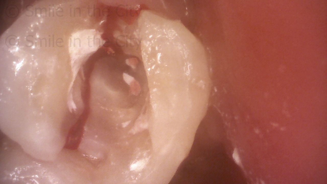 Cracked root canaled tooth without crown